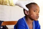 Monkeypox Outbreak news, Monkeypox Outbreak latest, is monkeypox outbreak coming to india, Mpox