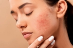 dermatologist, dermatologist, 10 ways to get rid of pimples at home, Unsc
